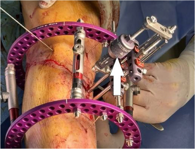 Exploring Tibial Cortex Transverse Transport (TTT) for Limb ...