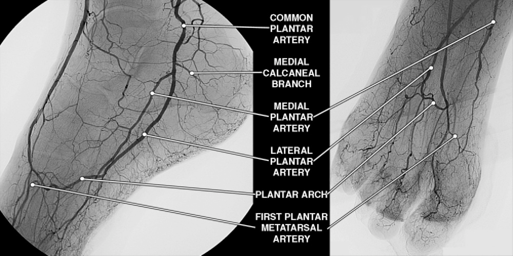 The Impact of Angiographic Pedal Circulation Status on Wound Healing in ...